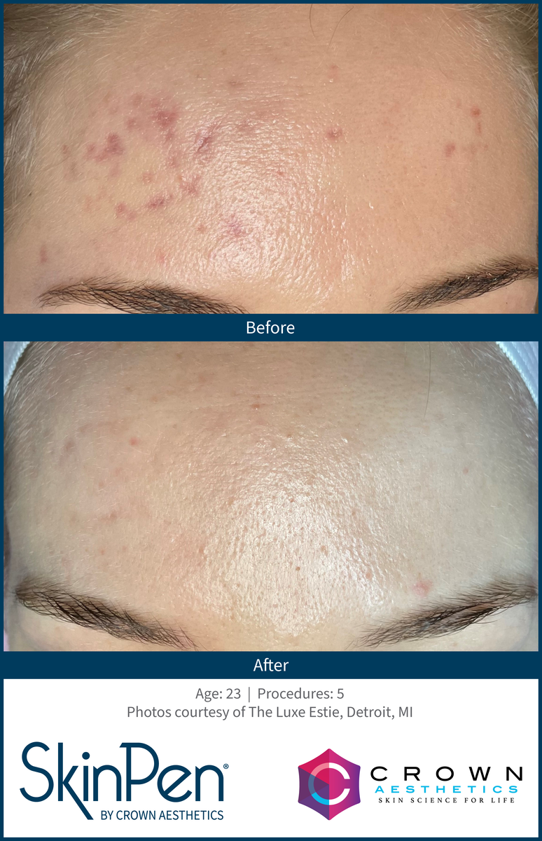 Before and After using SkinPen for Acne Treatment