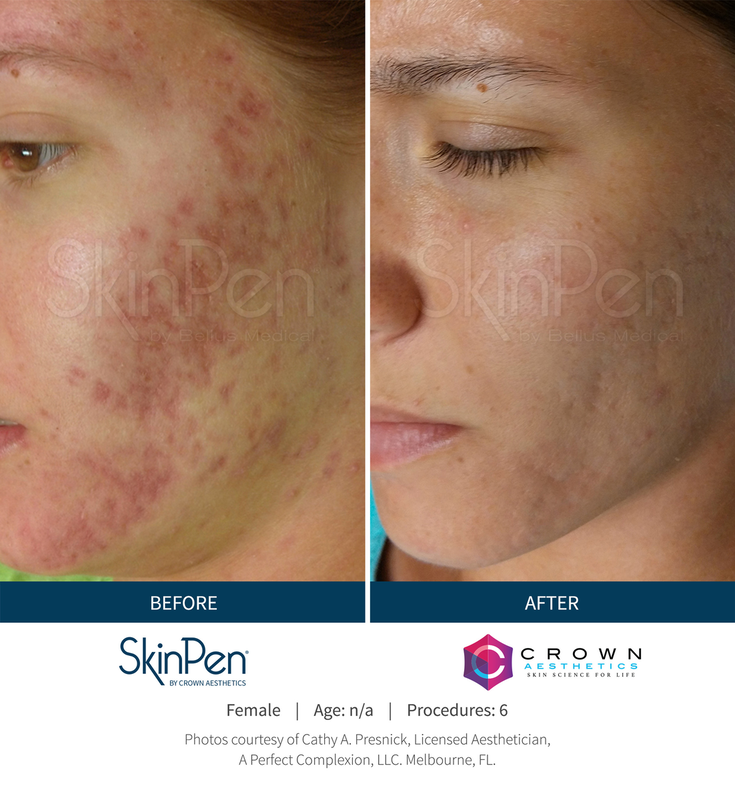 Before and After of using SkinPen as a treatment for facial scarring